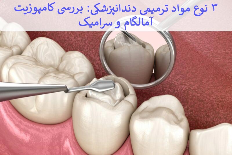 3 نوع مواد ترمیمی دندانپزشکی: بررسی کامپوزیت، آمالگام و سرامیک